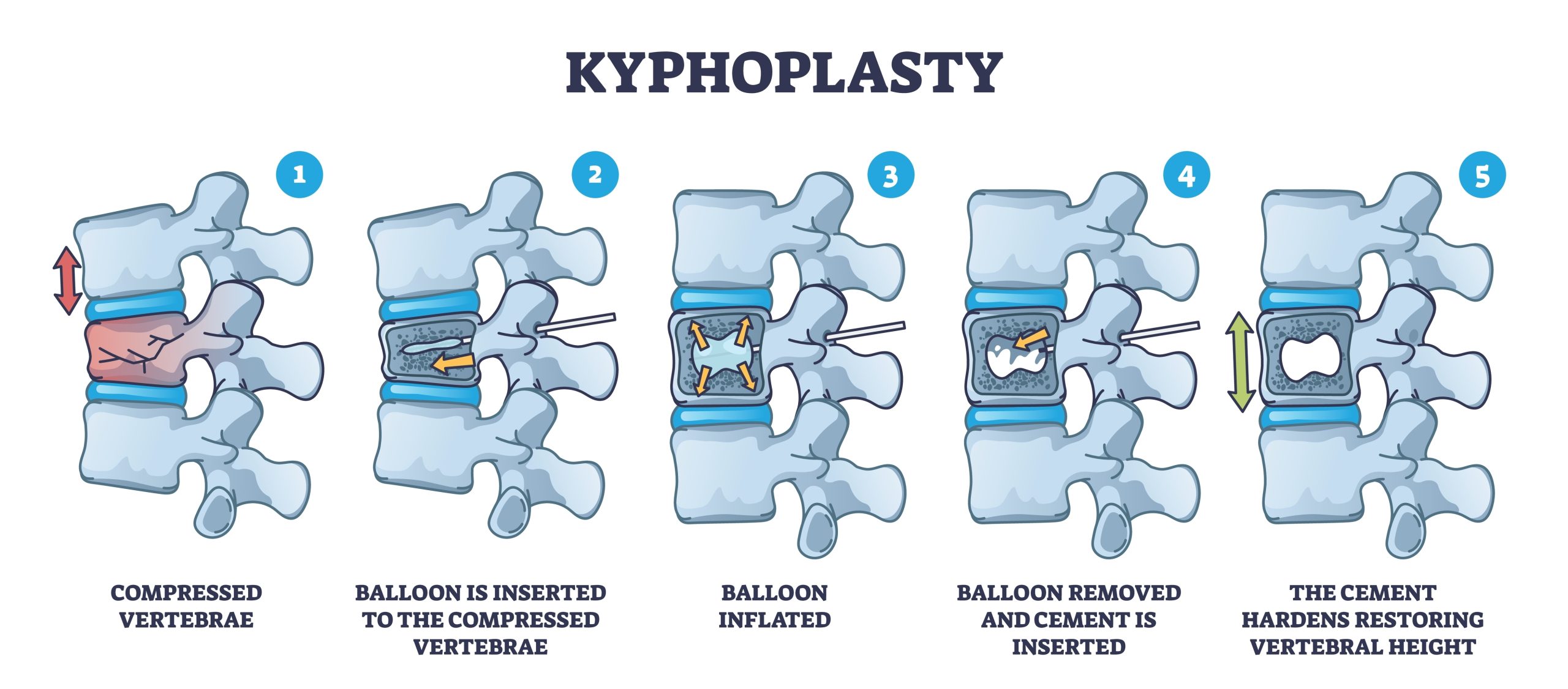Kyphoplasty: A Minimally Invasive Path to Pain Relief and Spinal Stability at APSI Wellness